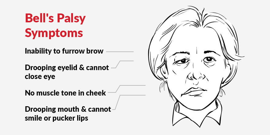 bell's palsy symptoms, facial paralysis, EMS Unit, electrical stimulation, head injuries