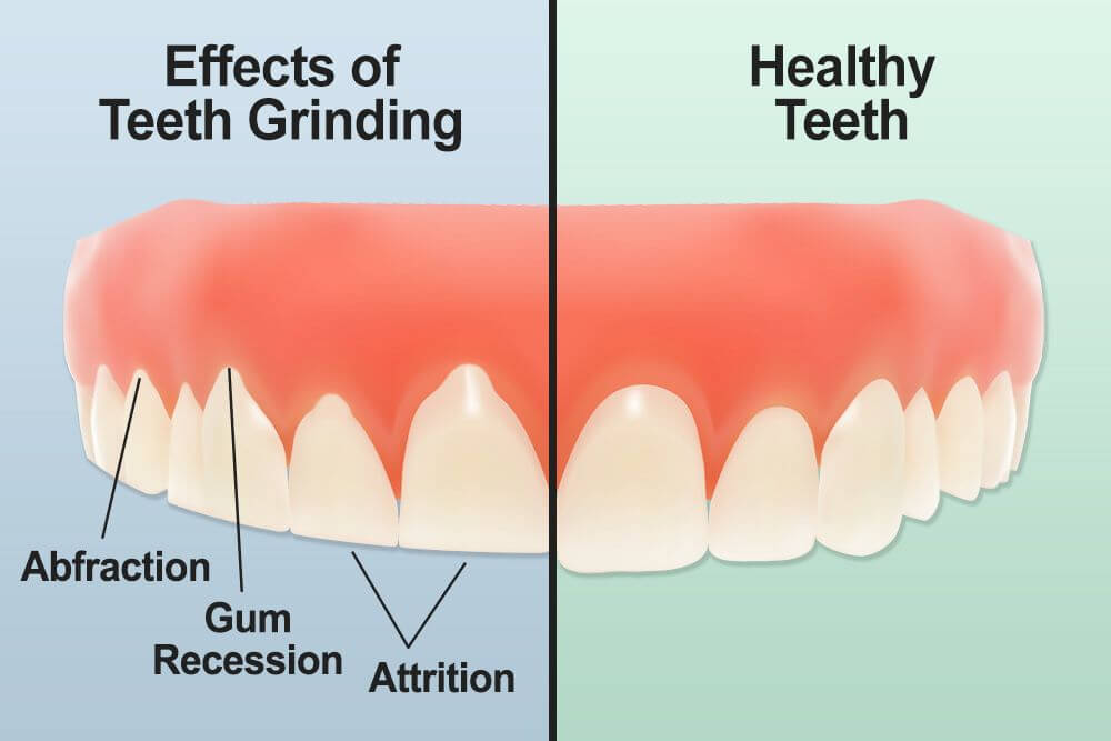 gum recession caused by teeth grinding