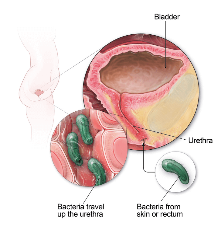  you can prevent UTIs if you maintain regular hygiene and empty your bladder before and after sexual activity