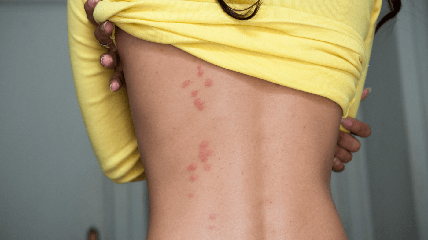 woman in hotel room with bed bug bites