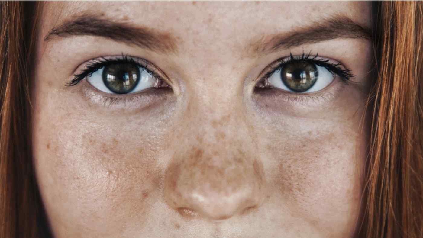 dark spots on woman's face