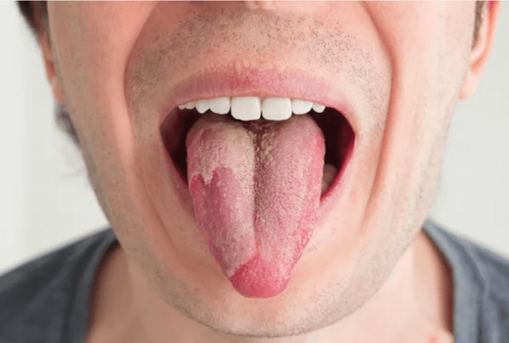 Oral Thrush | Can men get yeast infections | Condom Depot Learning Center