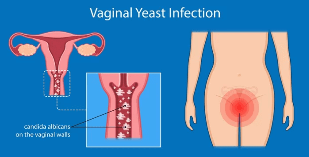Can Men Get Yeast Infections | Condom Depot Learning Center